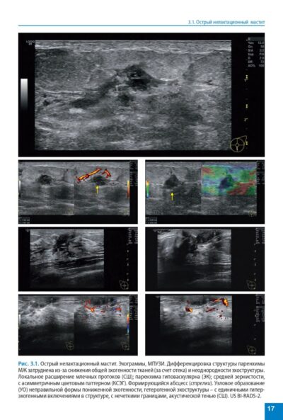 Атлас. Ультразвуковое исследование молочных желез — изображение 6