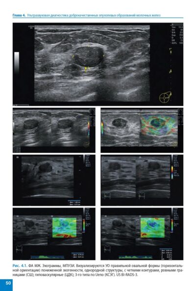 Атлас. Ультразвуковое исследование молочных желез — изображение 9