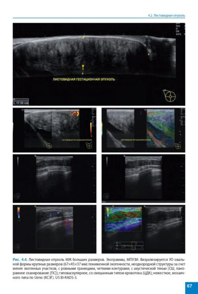 Атлас. Ультразвуковое исследование молочных желез — изображение 11