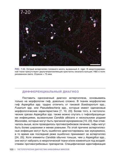 Гистологическая диагностика инвазивных микозов — изображение 13