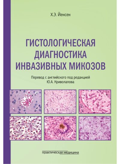 Гистологическая диагностика инвазивных микозов