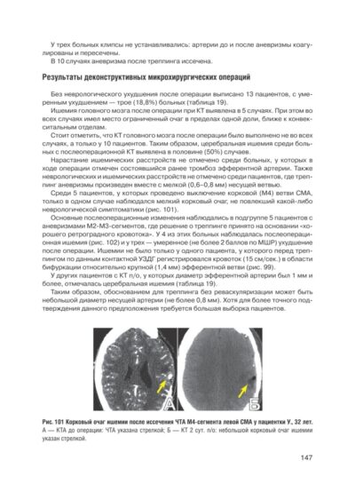 Микрохирургия сложных аневризм средних мозговых артерий: крупных, гигантских, фузиформных и частично тромбированных — изображение 8