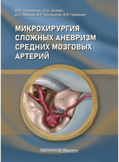 Микрохирургия сложных аневризм средних мозговых артерий: крупных, гигантских, фузиформных и частично тромбированных