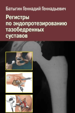 Регистр по эндопротезированию тазобедренных суставов