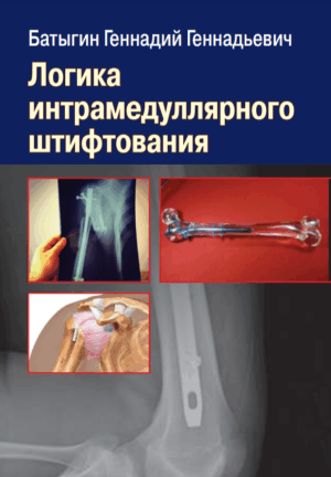 Логика интрамедуллярного штифтования тазобедренных суставов