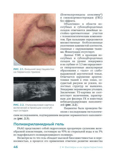 Постинъекционные осложнения в косметологии — изображение 2