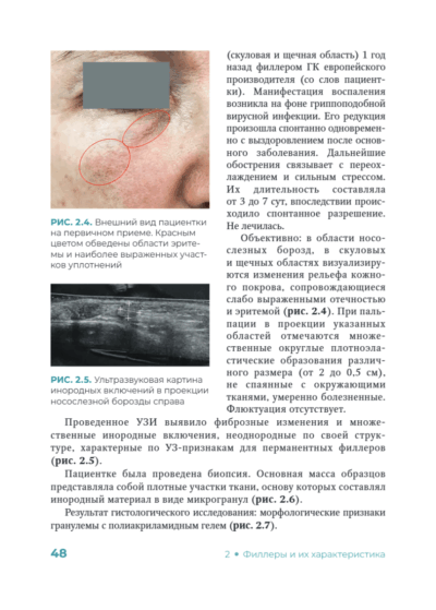 Постинъекционные осложнения в косметологии — изображение 8