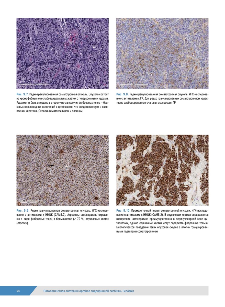 Патологическая анатомия органов эндокринной системы. Гипофиз — изображение 13