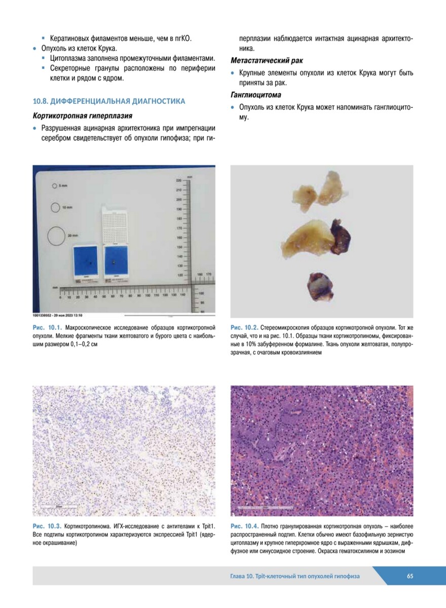 Патологическая анатомия органов эндокринной системы. Гипофиз — изображение 12