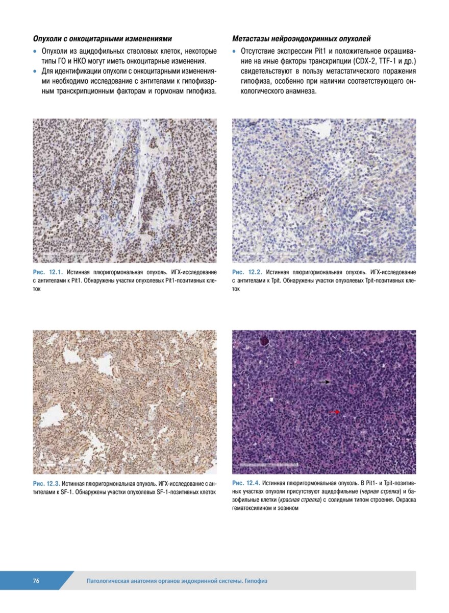Патологическая анатомия органов эндокринной системы. Гипофиз — изображение 11