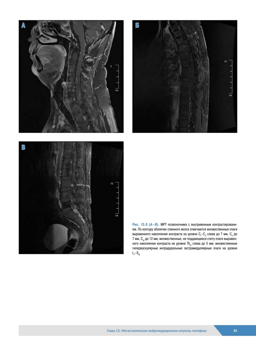Патологическая анатомия органов эндокринной системы. Гипофиз — изображение 10