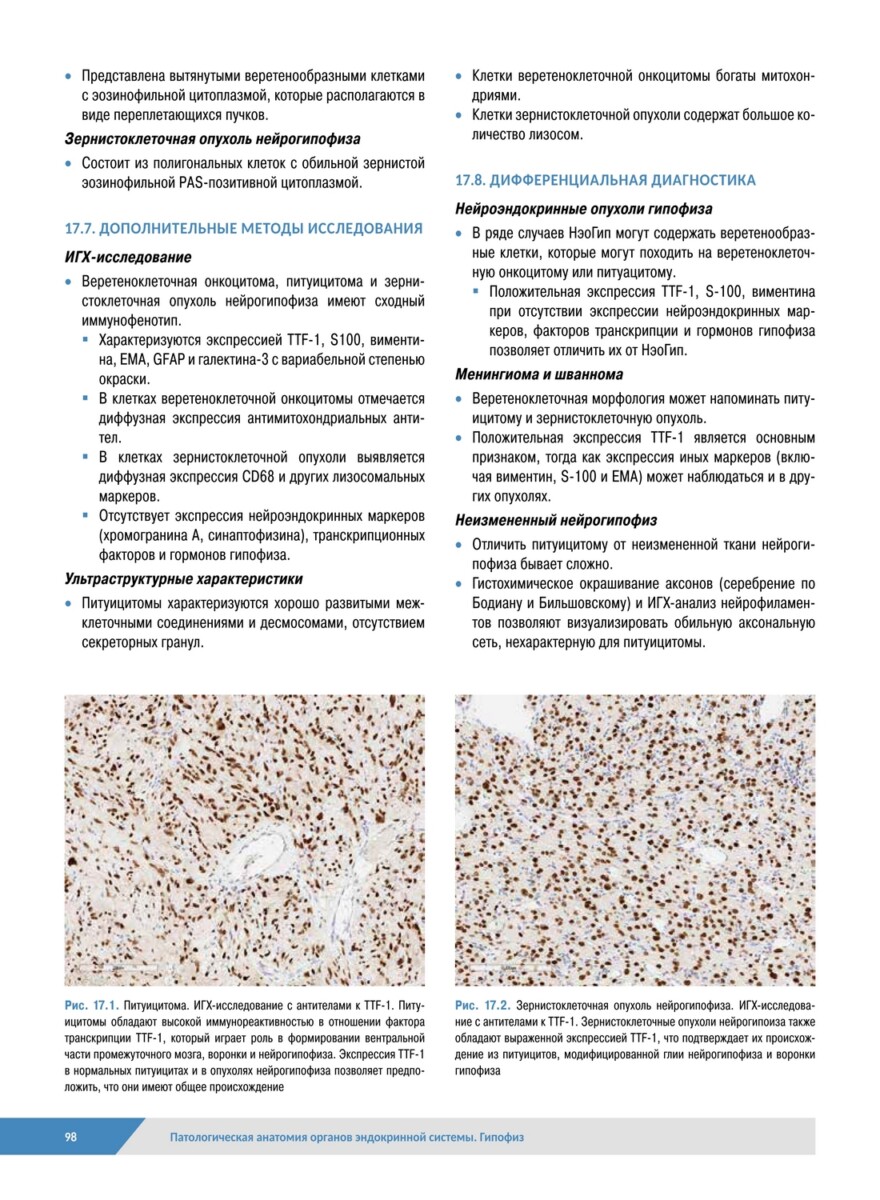 Патологическая анатомия органов эндокринной системы. Гипофиз — изображение 9