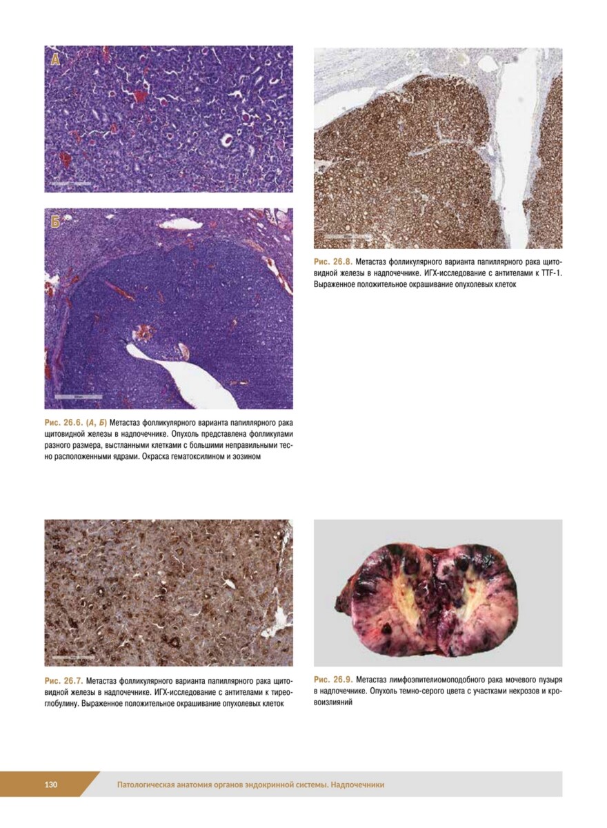 Патологическая анатомия органов эндокринной системы. Надпочечники — изображение 14