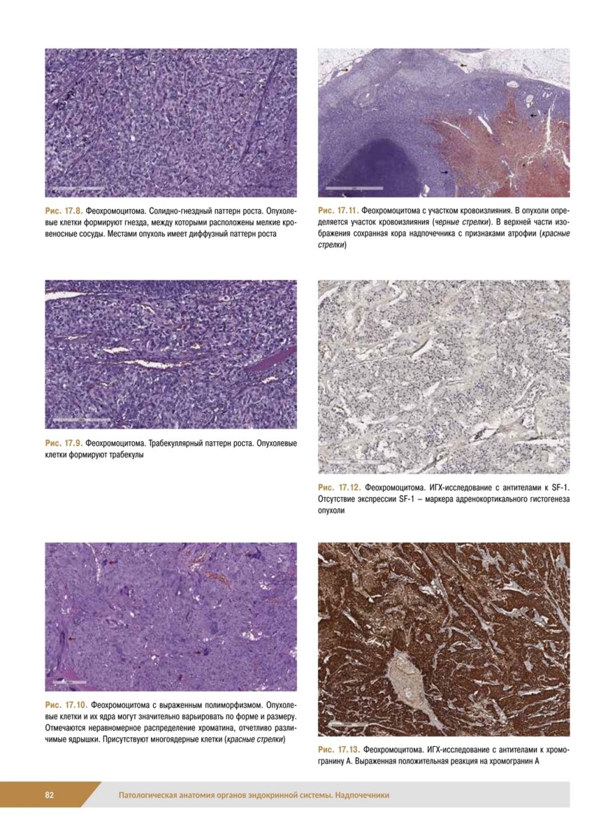 Патологическая анатомия органов эндокринной системы. Надпочечники — изображение 2