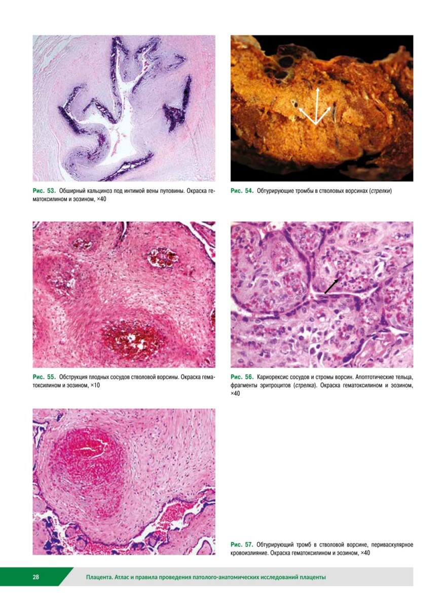 Плацента. Атлас и правила проведения патолого-анатомических исследований — изображение 7