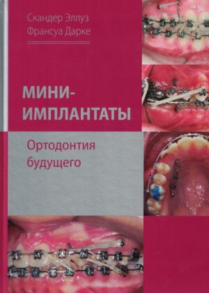 Мини-имплантаты. Ортодонтия будущего