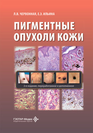 Пигментные опухоли кожи